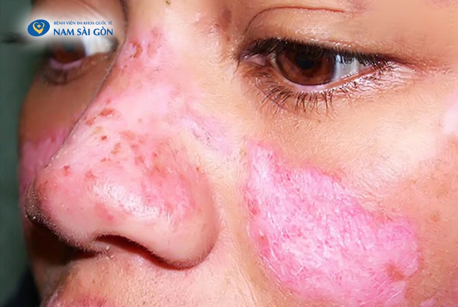 NHỮNG DẤU HIỆU CẢNH BÁO VÀ CÁCH CHĂM SÓC DÀNH CHO NGƯỜI BỆNH LUPUS BAN ĐỎ