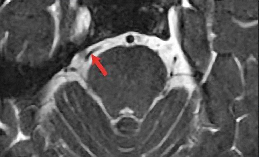 đau dây thần kinh tam thoa