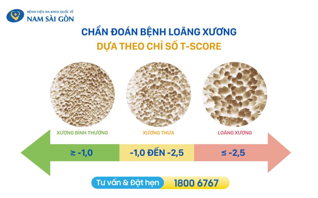 Xác định mật độ xương