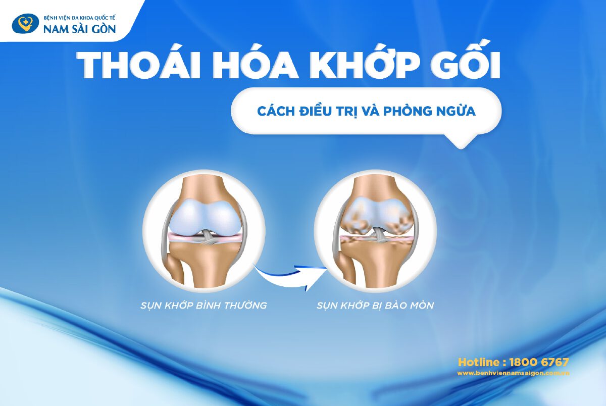 THOÁI HÓA KHỚP GỐI – NGUYÊN NHÂN, TRIỆU CHỨNG, ĐIỀU TRỊ VÀ PHÒNG NGỪA