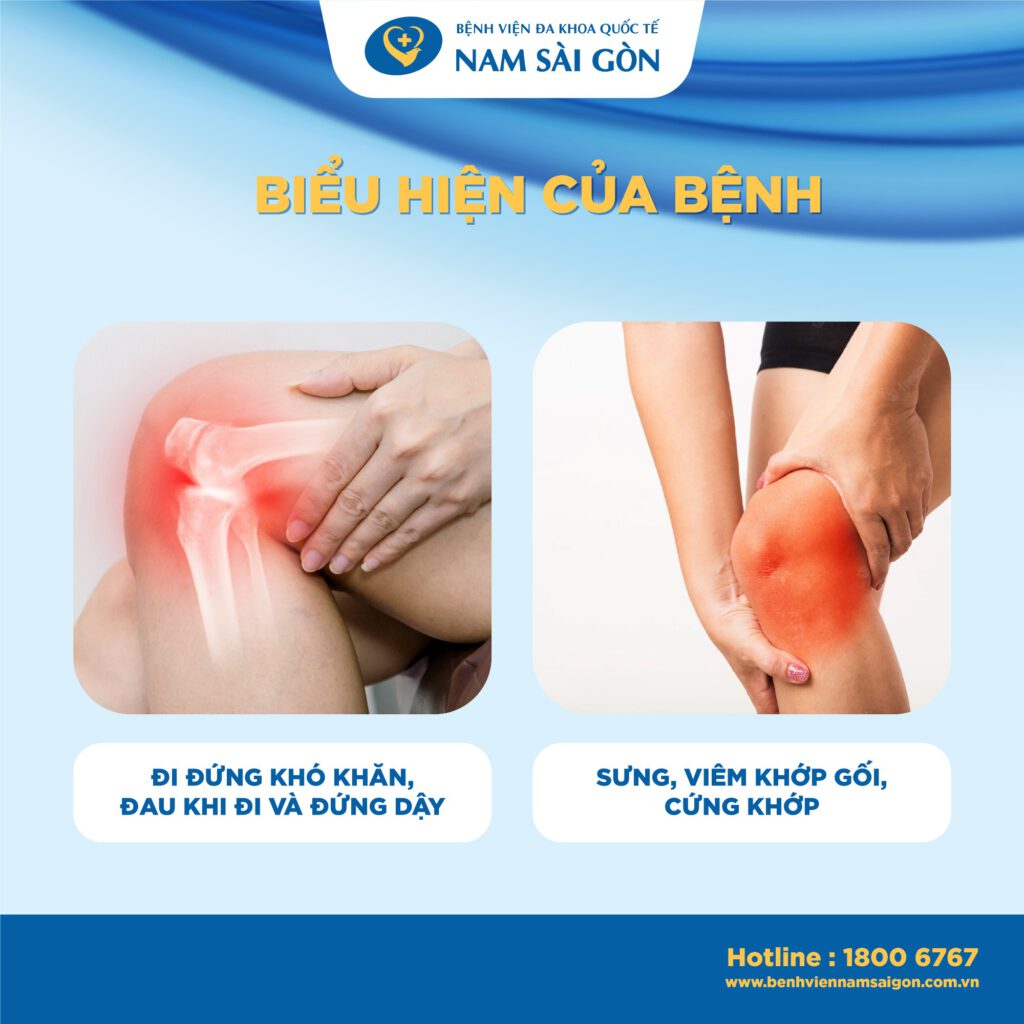 dấu hiệu thoái hóa khớp gối triệu chứng thoái hóa khớp gối