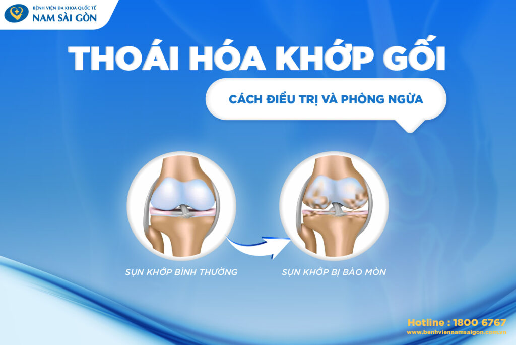 thoái hóa khớp gối là gì bệnh thoái hóa khớp gối là gì