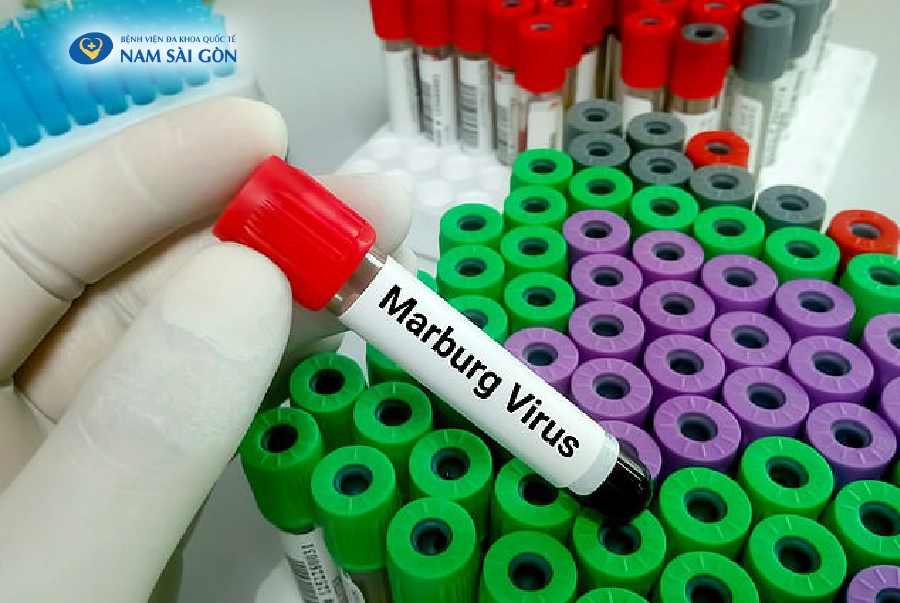 NHỮNG ĐIỀU CẦN BIẾT VỀ VIRUS MARBURG GÂY BỆNH SỐT XUẤT HUYẾT