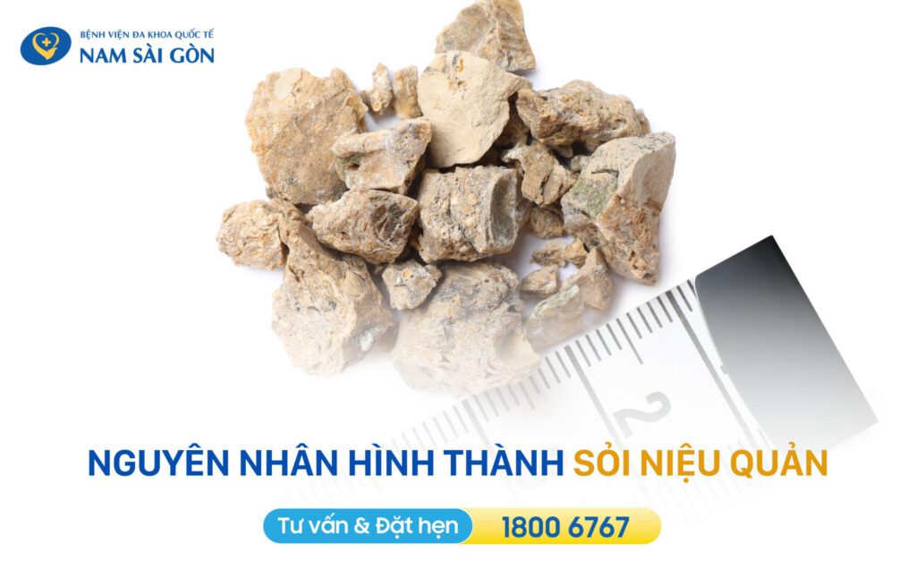 Nguyên nhân hình thành sỏi niệu quản