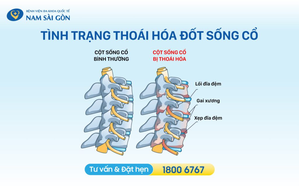 cột sống cổ khi bị thoái hóa
