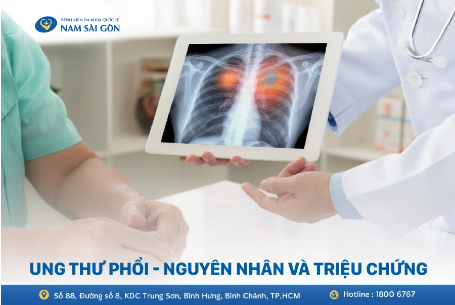 UNG THƯ PHỔI – NGUYÊN NHÂN, DẤU HIỆU, CHẨN ĐOÁN VÀ CÁCH ĐIỀU TRỊ