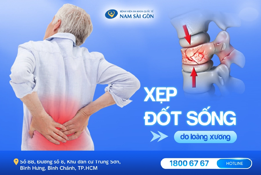 XẸP ĐỐT SỐNG DO LOÃNG XƯƠNG – NGUYÊN NHÂN, DẤU HIỆU, CHẨN ĐOÁN & ĐIỀU TRỊ
