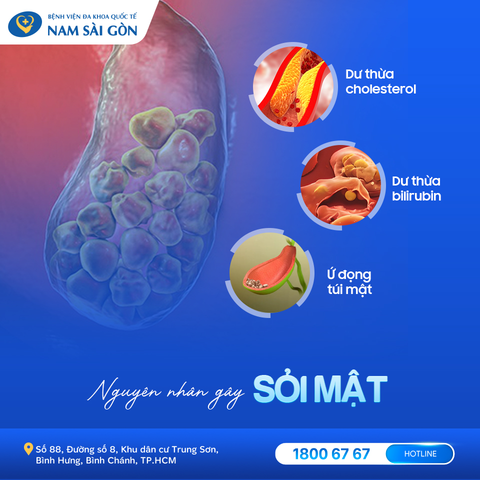 nguyên nhân gây sỏi túi mật