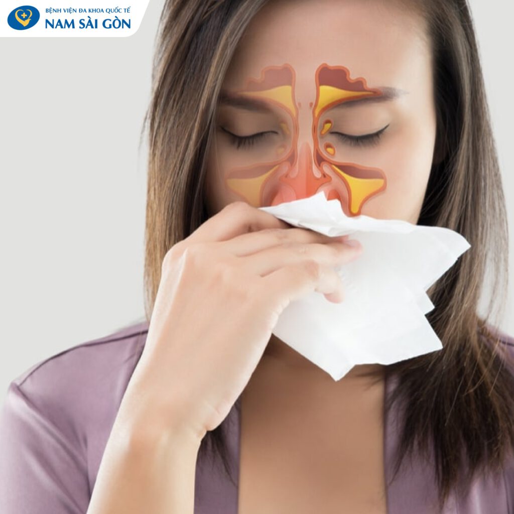 xoang bướm là gì Dấu hiệu của bệnh viêm xoang bướm