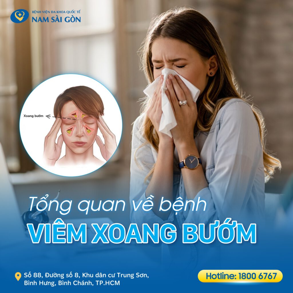 viêm xoang bướm Viêm xoang bướm là gì