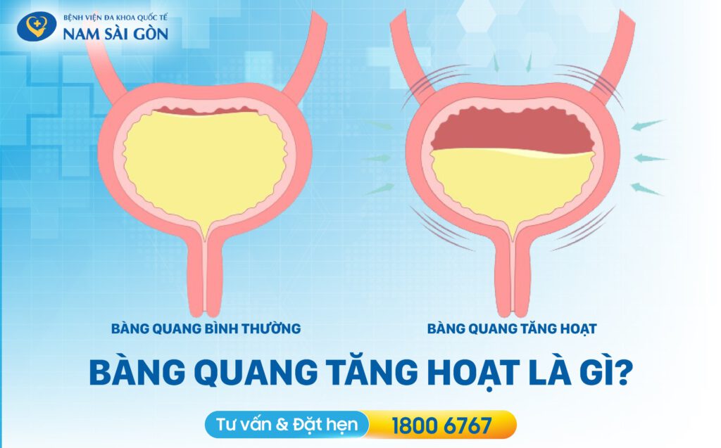 bàng quang tăng hoạt bàng quang tăng hoạt là gì