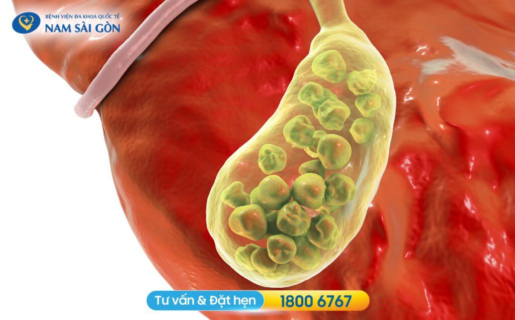 nguyên nhân đau túi mật