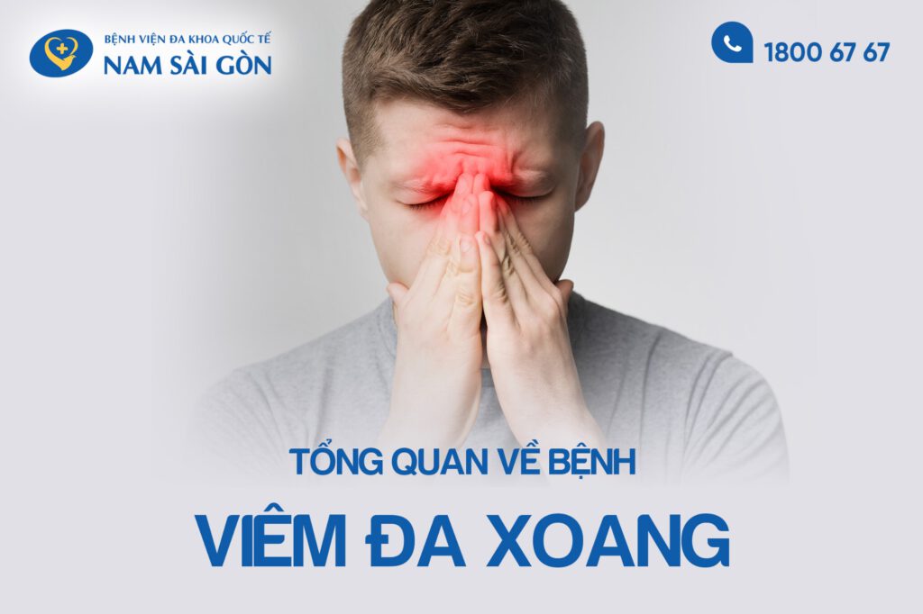 viêm đa xoang là gì
