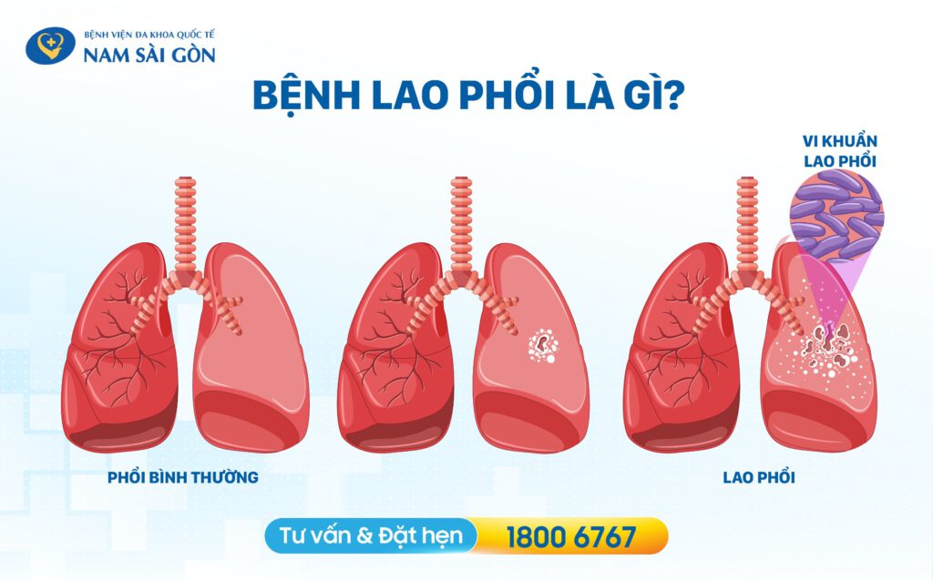 bệnh lao phổi bệnh lao phổi là gì