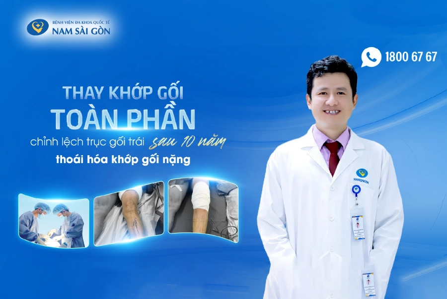 THAY KHỚP GỐI TOÀN PHẦN CHỈNH LỆCH TRỤC GỐI TRÁI SAU 10 NĂM THOÁI HÓA KHỚP GỐI NẶNG