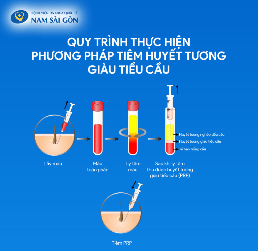 phương pháp prp huyết tương giàu tiểu cầu phương pháp tiêm huyết tương giàu tiểu cầu