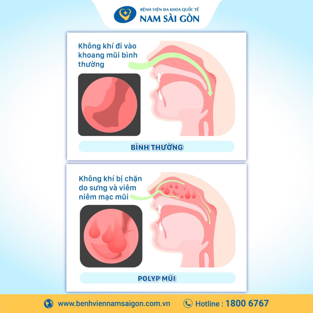 polyp bên trong lỗ mũi bình thường hình ảnh polyp mũi