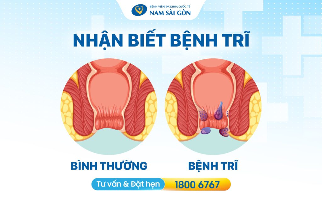 nguyên nhân bị trĩ