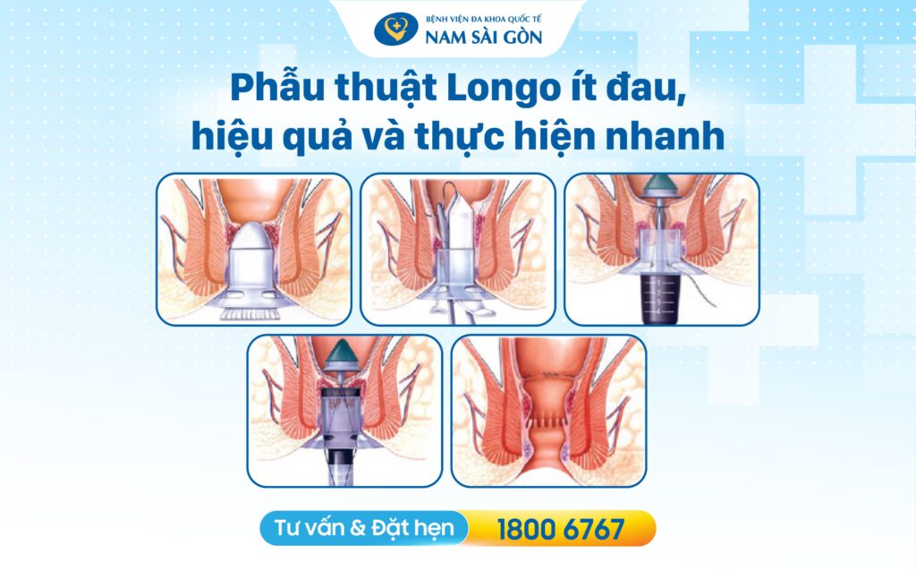 Phẫu thuật Longo