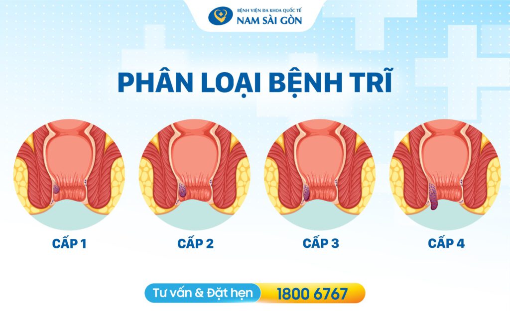 các loại trĩ