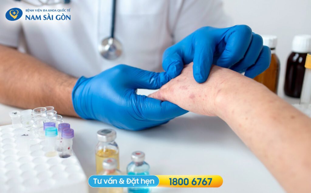 Chẩn đoán viêm da cơ địa