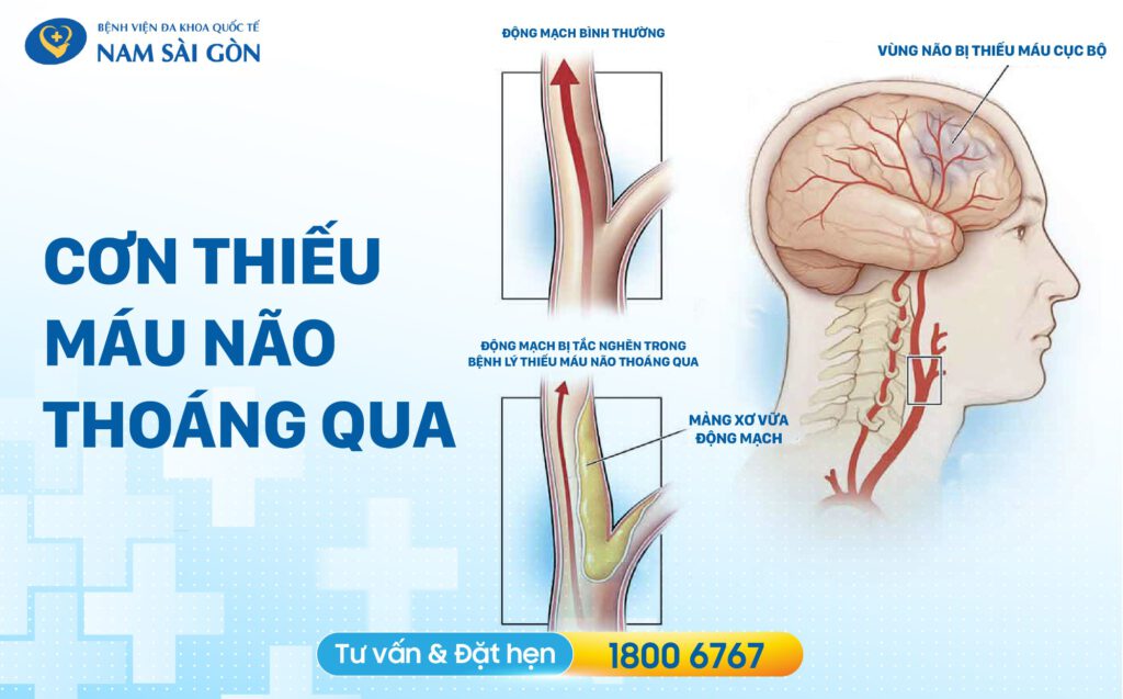cơn thiếu máu não thoáng qua