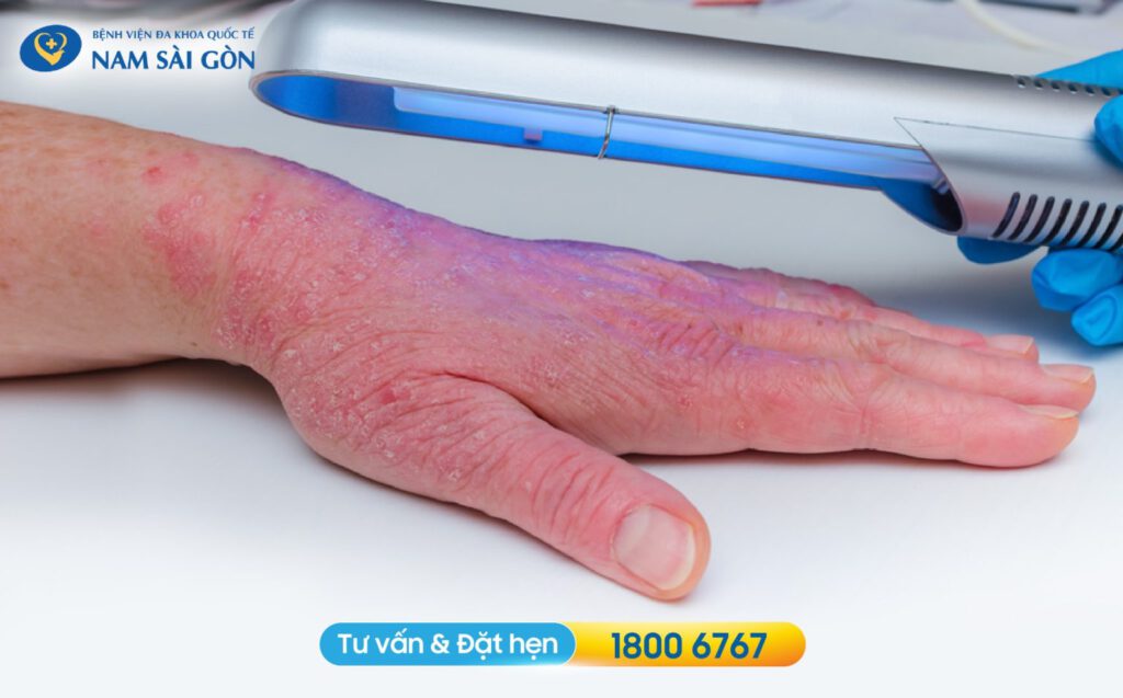 Điều trị viêm da cơ địa