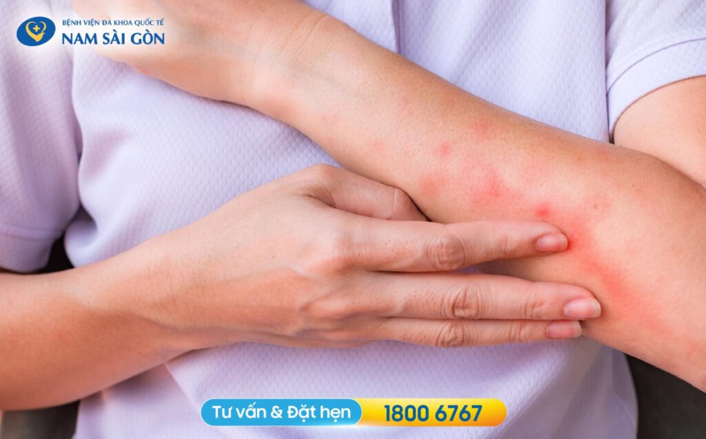 dấu hiệu viêm da cơ địa dấu hiệu nhận biết viêm da cơ địa