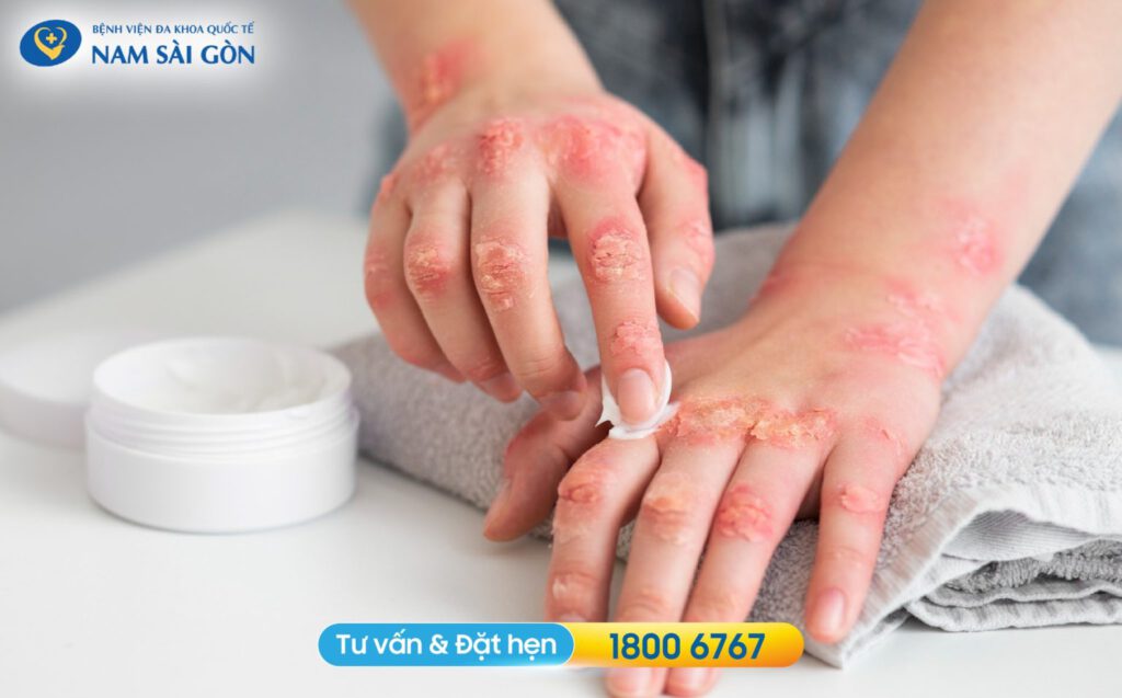 dấu hiệu nhận biết viêm da cơ địa dấu hiệu viêm da cơ địa