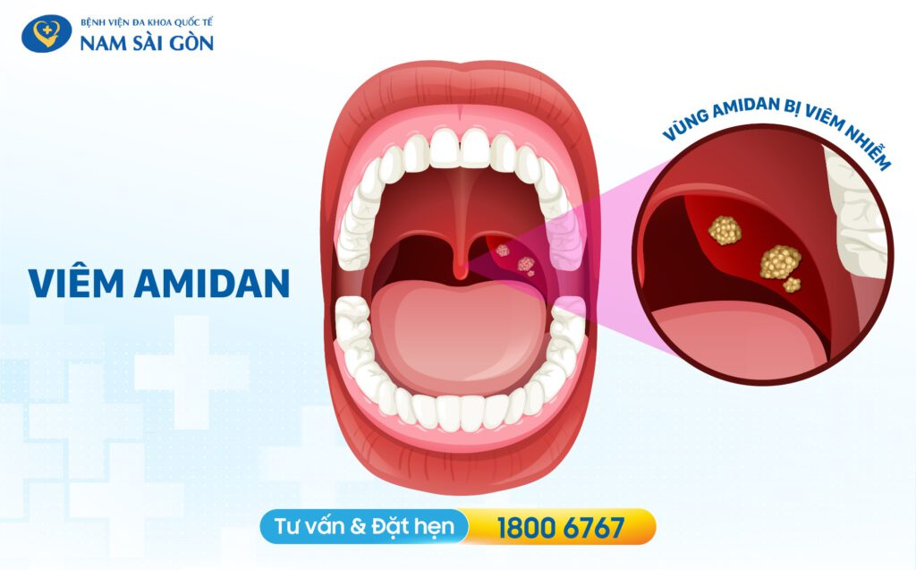 viem amidan viêm amidan là gì