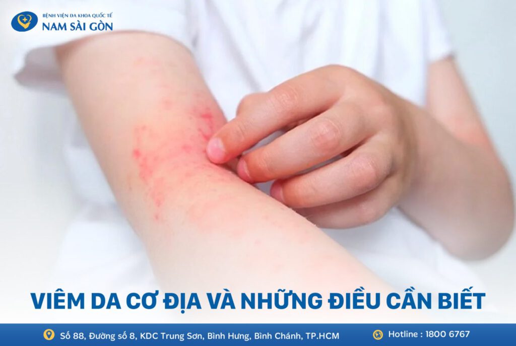 viêm da cơ địa là gì bệnh viêm da cơ địa là gì