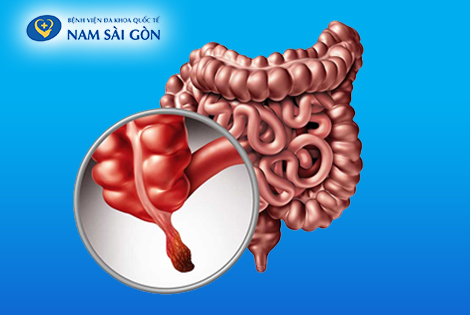 VIÊM RUỘT THỪA KHI NÀO CẦN CẮT?