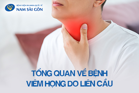 VIÊM HỌNG DO LIÊN CẦU KHUẨN – NGUYÊN NHÂN, TRIỆU CHỨNG, CÁCH ĐIỀU TRỊ