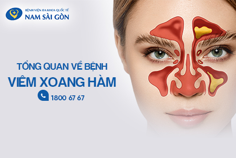 VIÊM XOANG HÀM: NGUYÊN NHÂN, CHUẨN ĐOÁN, ĐIỀU TRỊ VÀ PHÒNG TRÁNH