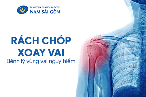 RÁCH CƠ CHÓP XOAY VAI – NGUYÊN NHÂN, TRIỆU CHỨNG VÀ CÁCH ĐIỀU TRỊ