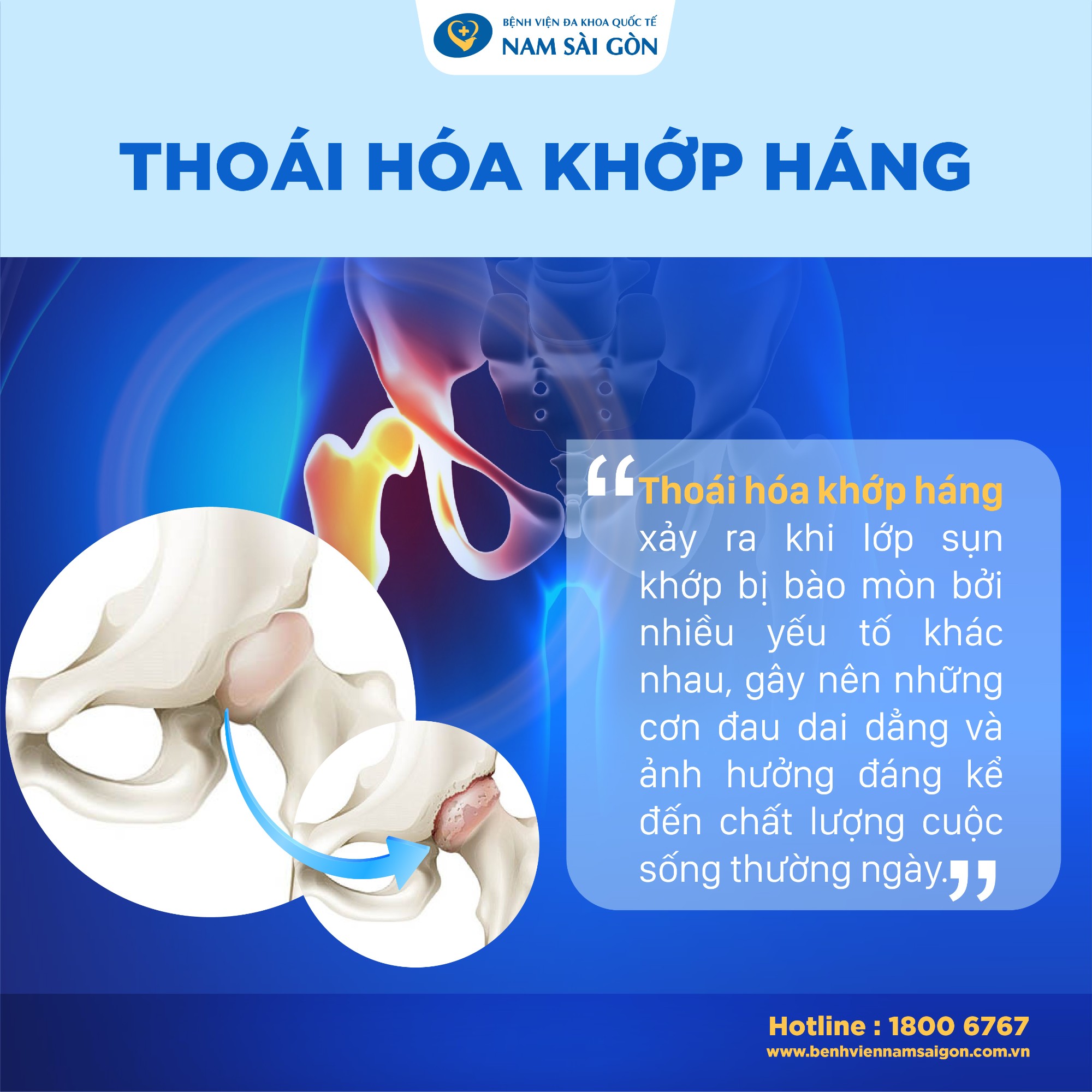 thoai hoa khop hang Thoái hóa khớp háng là gì
