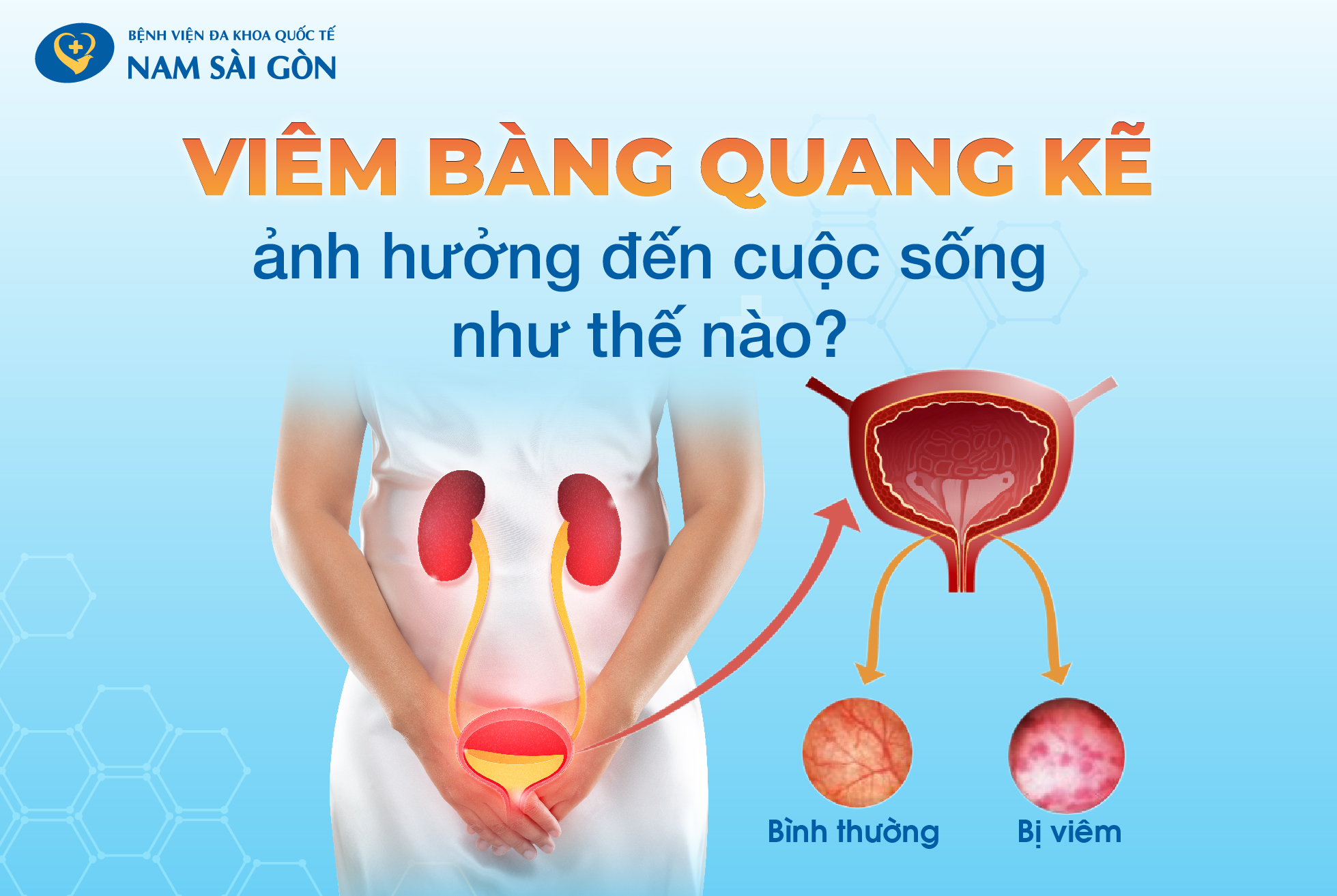 VIÊM BÀNG QUANG KẼ – NGUYÊN NHÂN, TRIỆU CHỨNG, BIẾN CHỨNG VÀ ĐIỀU TRỊ