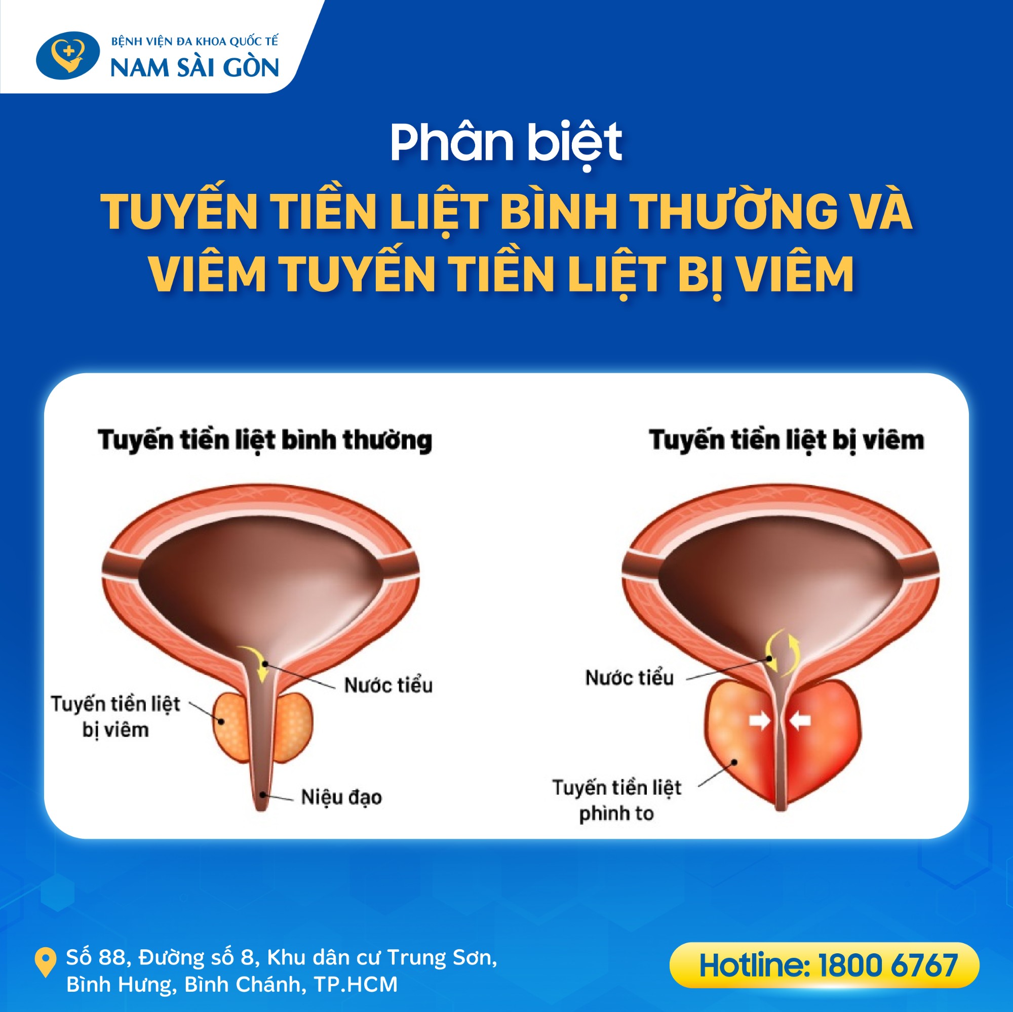 dau_hieu_viem_tuyen_tien_liet_03 Nguyên nhân và yếu tố nguy cơ gây viêm tuyến tiền liệt mãn tính