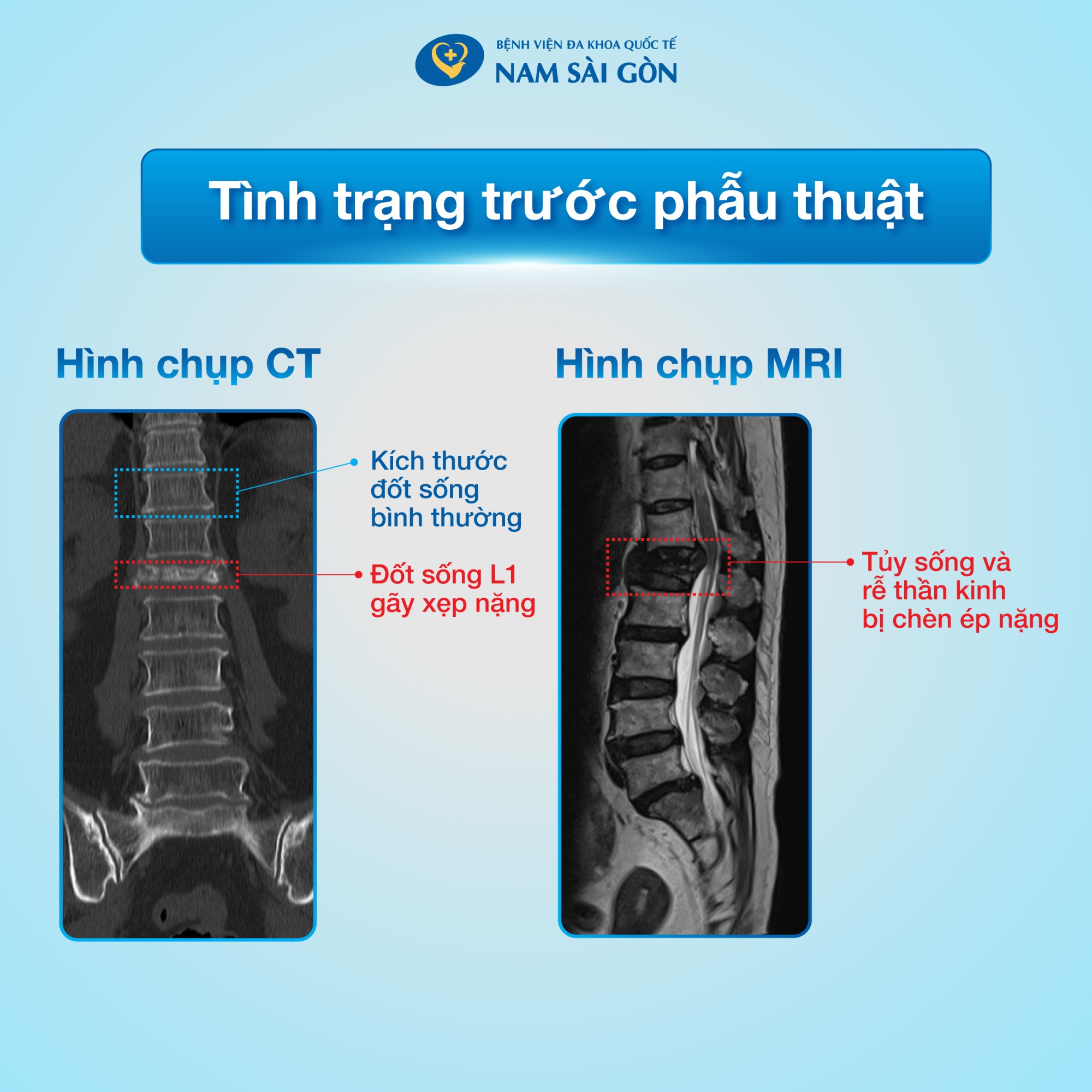 dieu_tri_gay_xep_dot_song_04_facebook_web-7