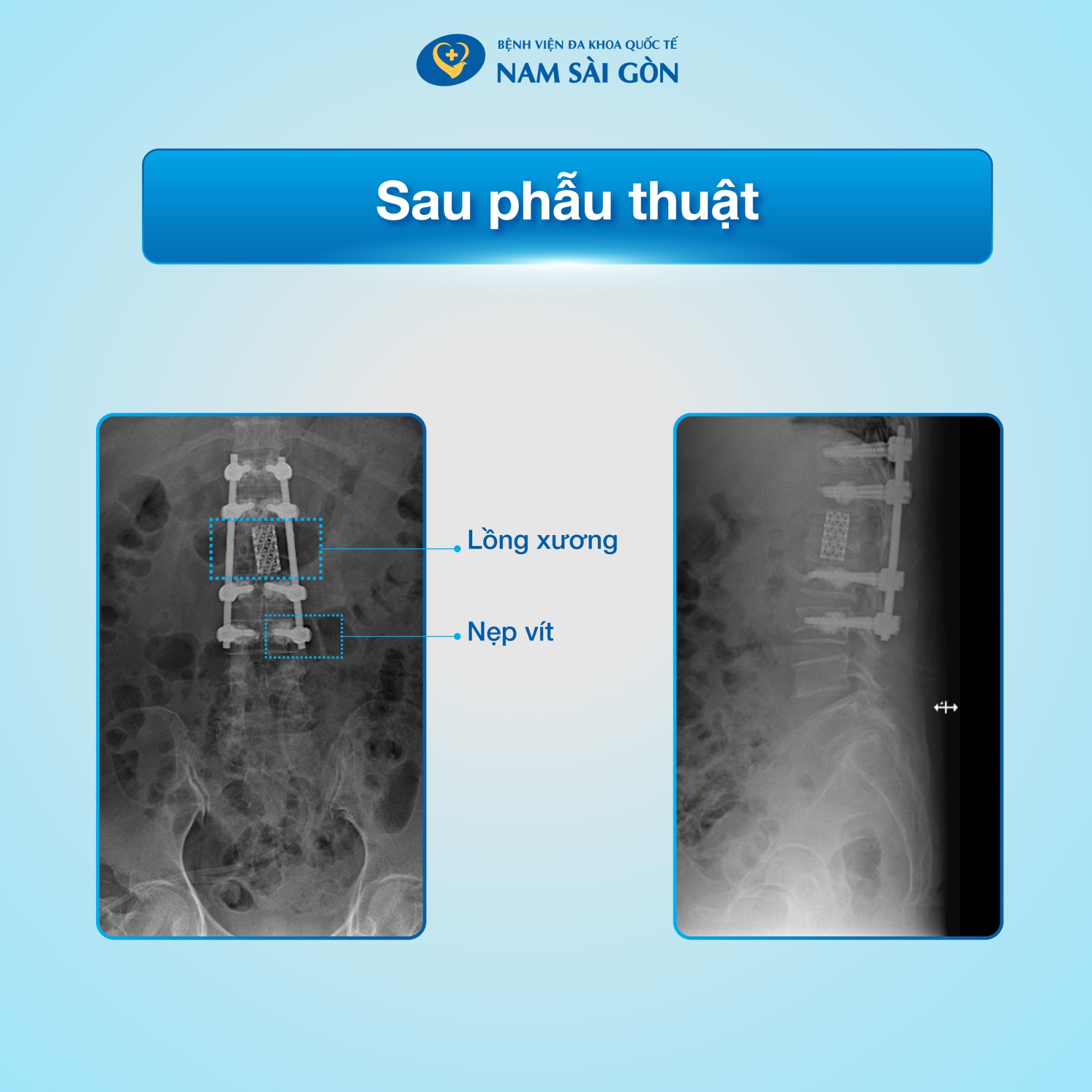 dieu_tri_gay_xep_dot_song_05_facebook_web-7