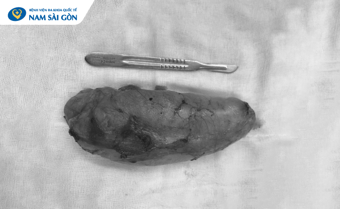 khoi_u_mo_lon_o_dui_2-1