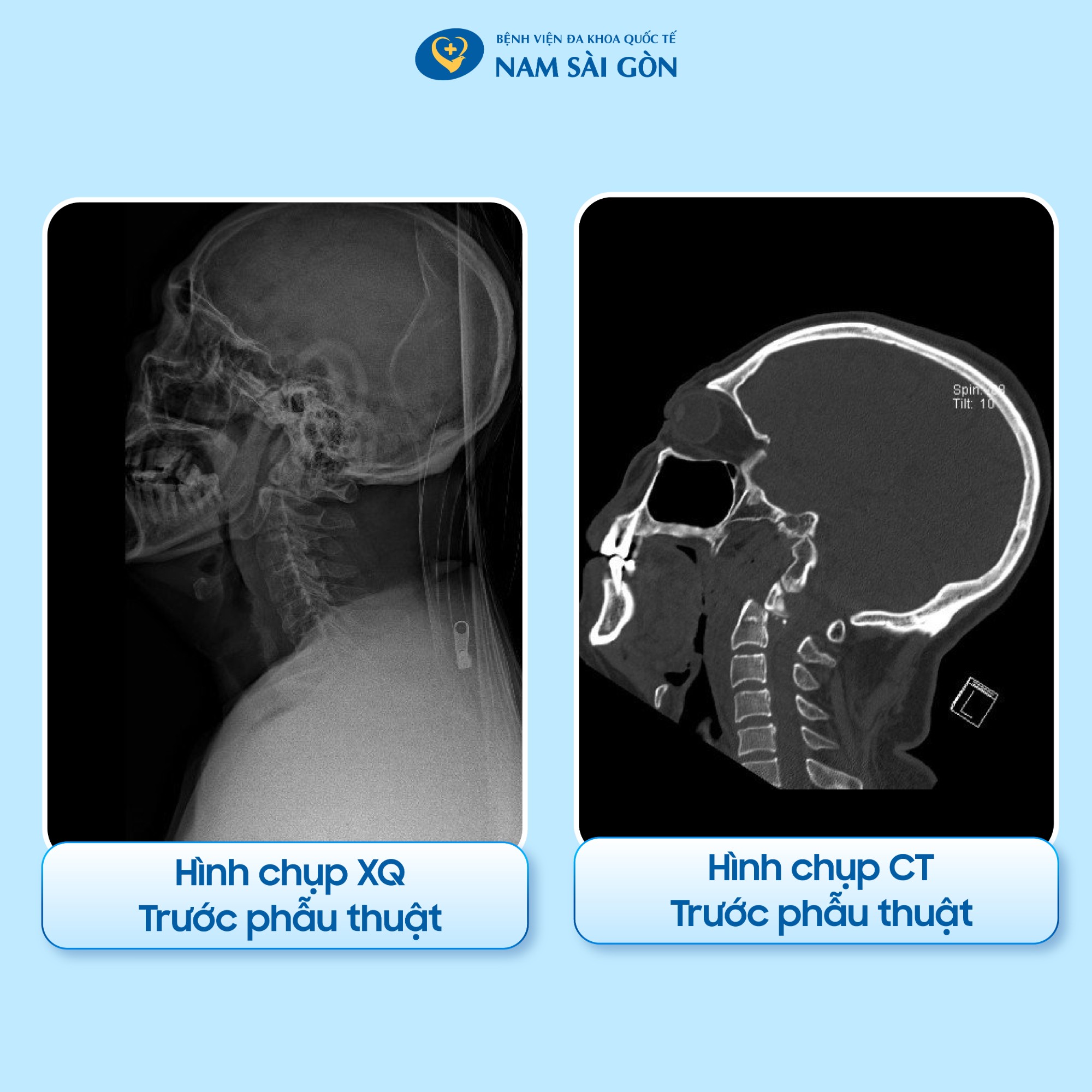 nguoi_gay_co_suyt_liet_tu_chi_02-2