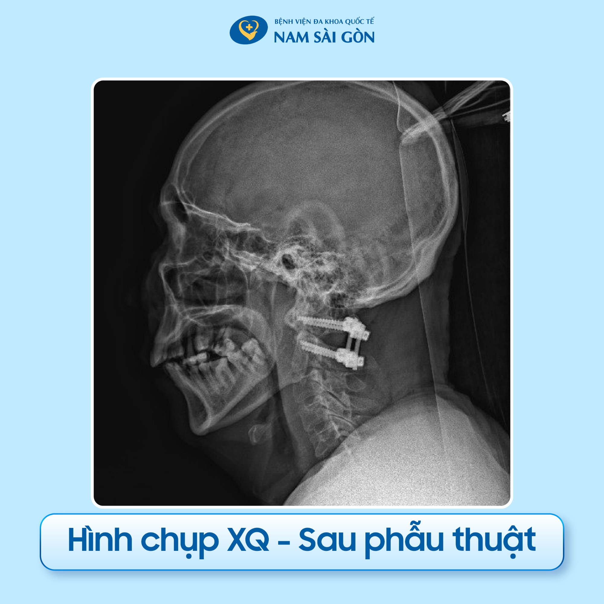 nguoi_gay_co_suyt_liet_tu_chi_03-2