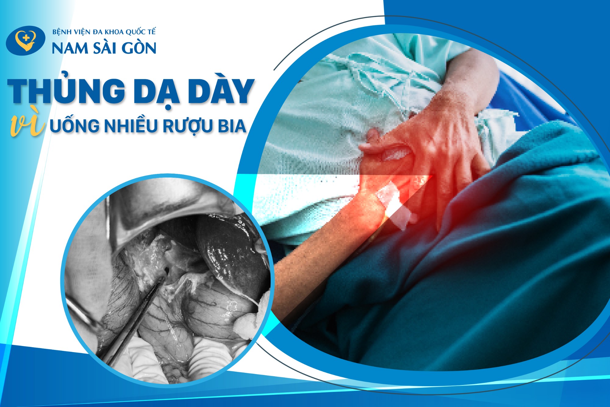 ជំងឺឆ្លាយក្រពះដោយសារញាំស្រាបៀរច្រើន