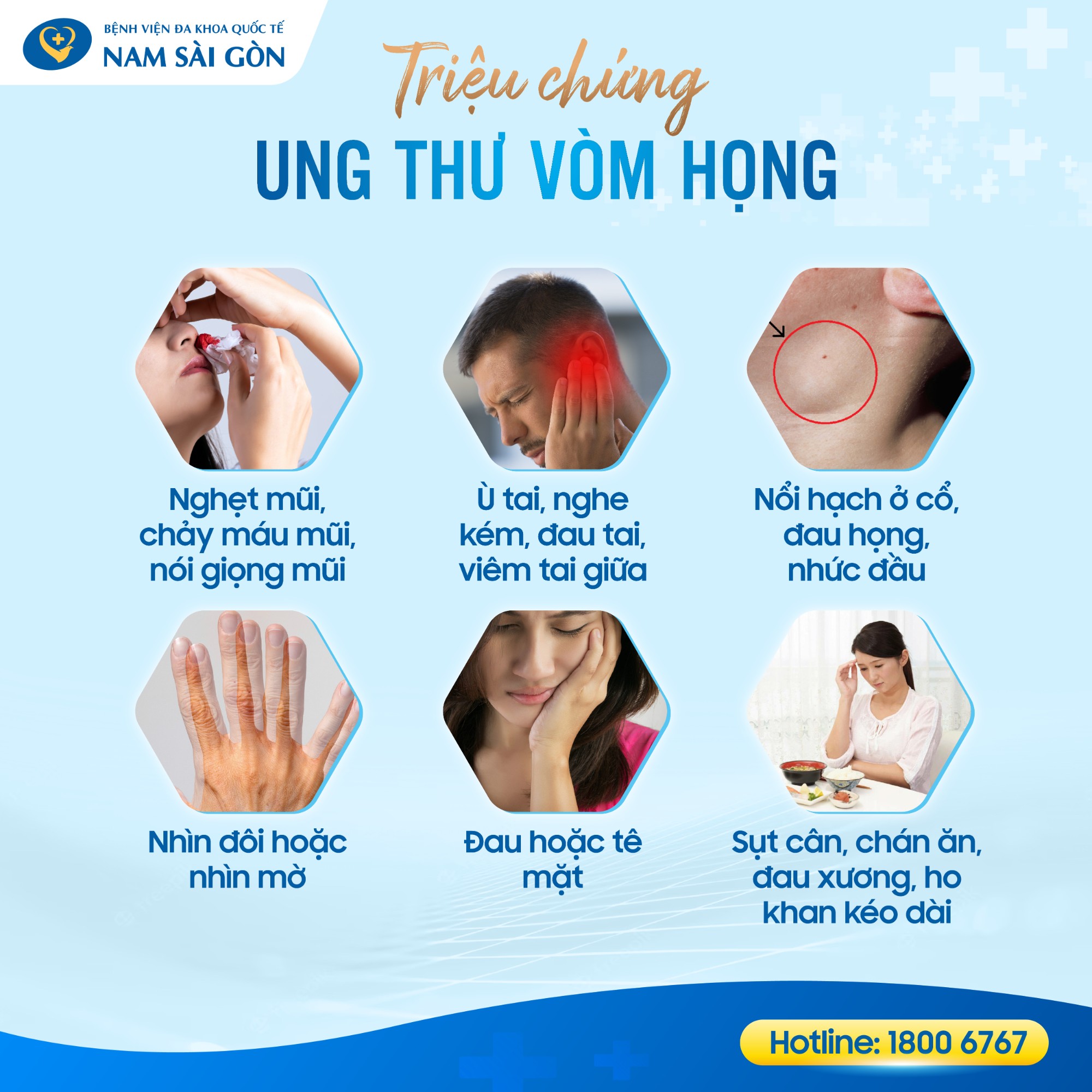 Triệu Chứng Ung Thư Vòm Họng