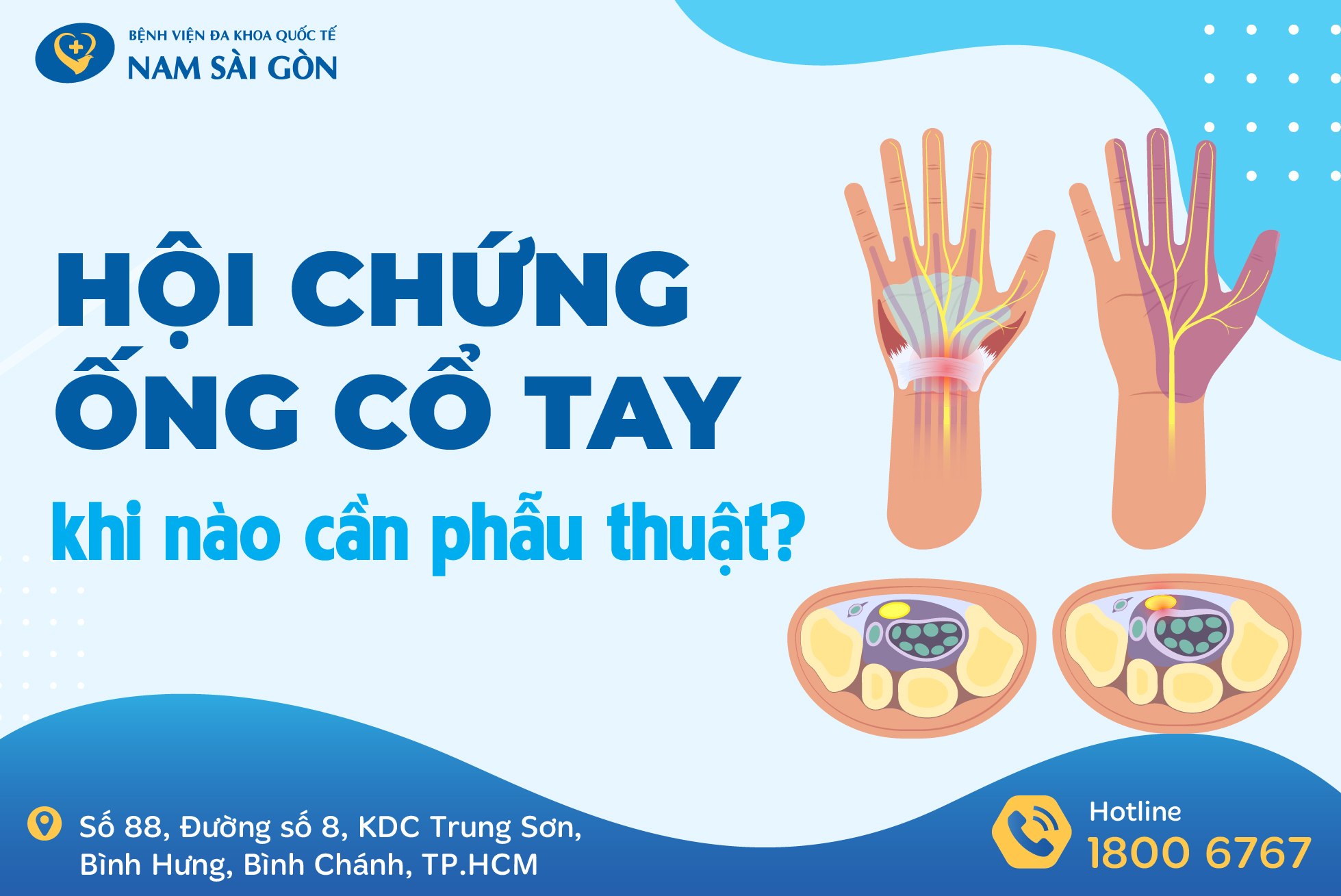HỘI CHỨNG ỐNG CỔ TAY – NGUYÊN NHÂN, TRIỆU CHỨNG, ĐIỀU TRỊ VÀ PHÒNG NGỪA