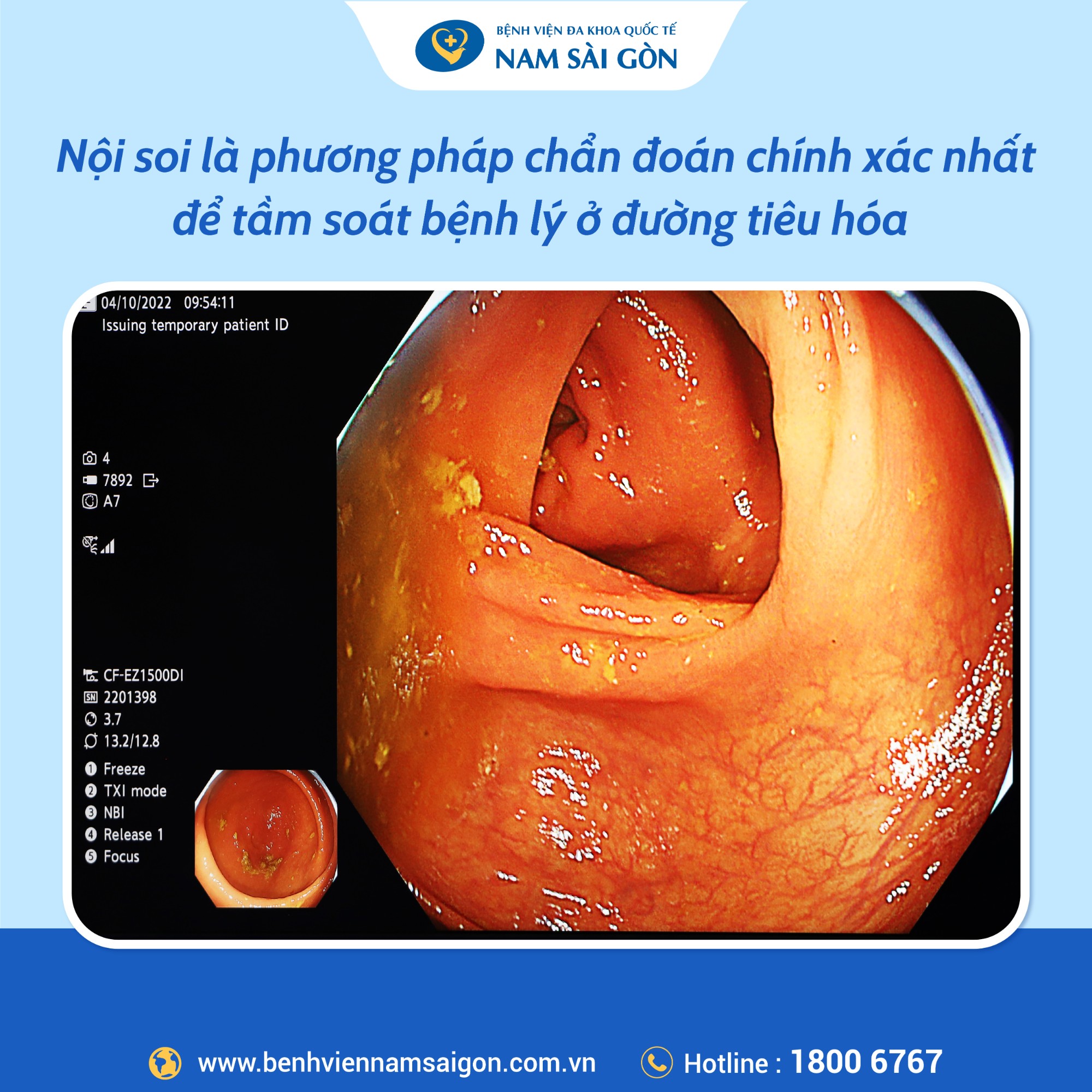 post may noi soi cv1500 02 1