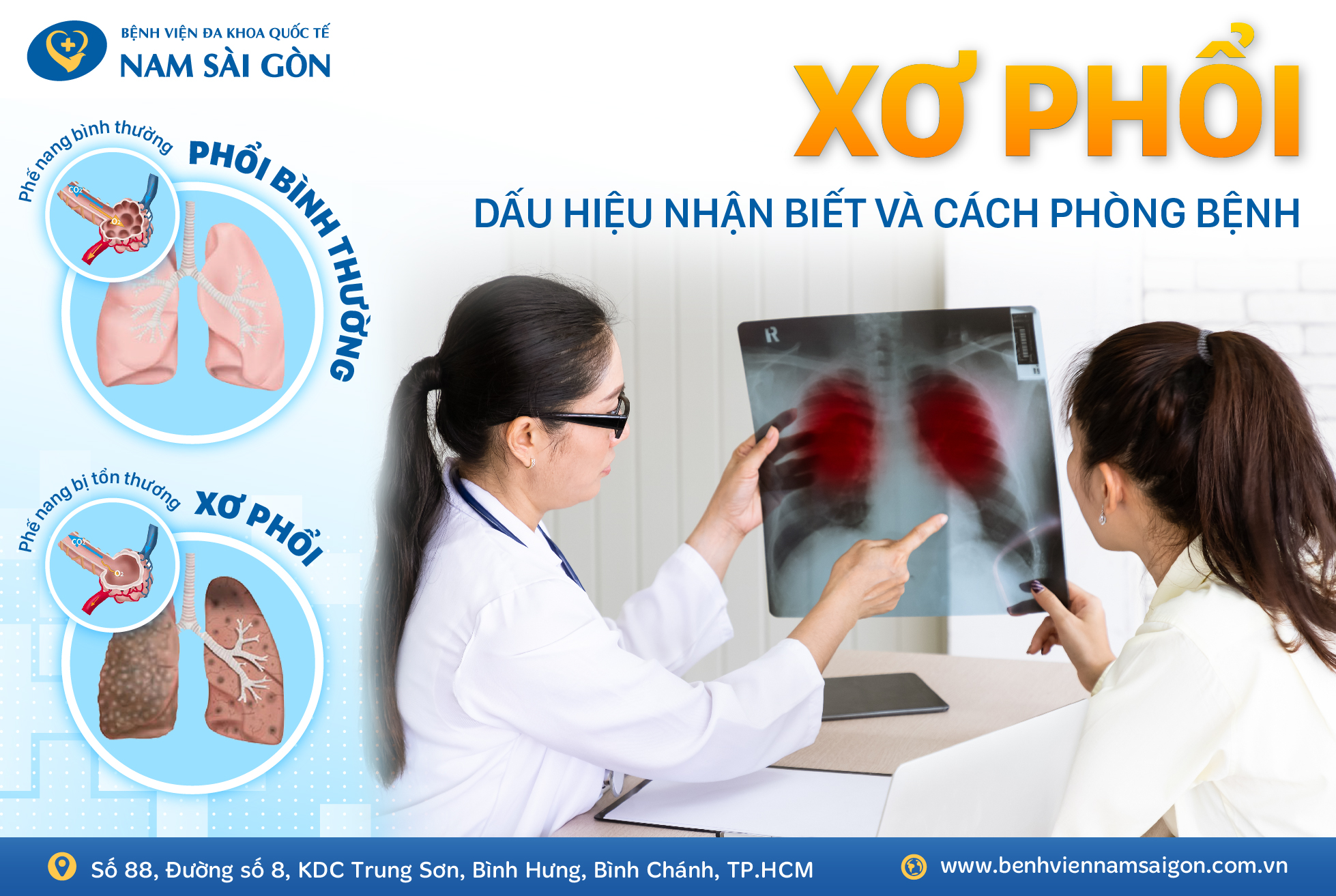 XƠ PHỔI – NGUYÊN NHÂN, DẤU HIỆU VÀ CÁCH ĐIỀU TRỊ