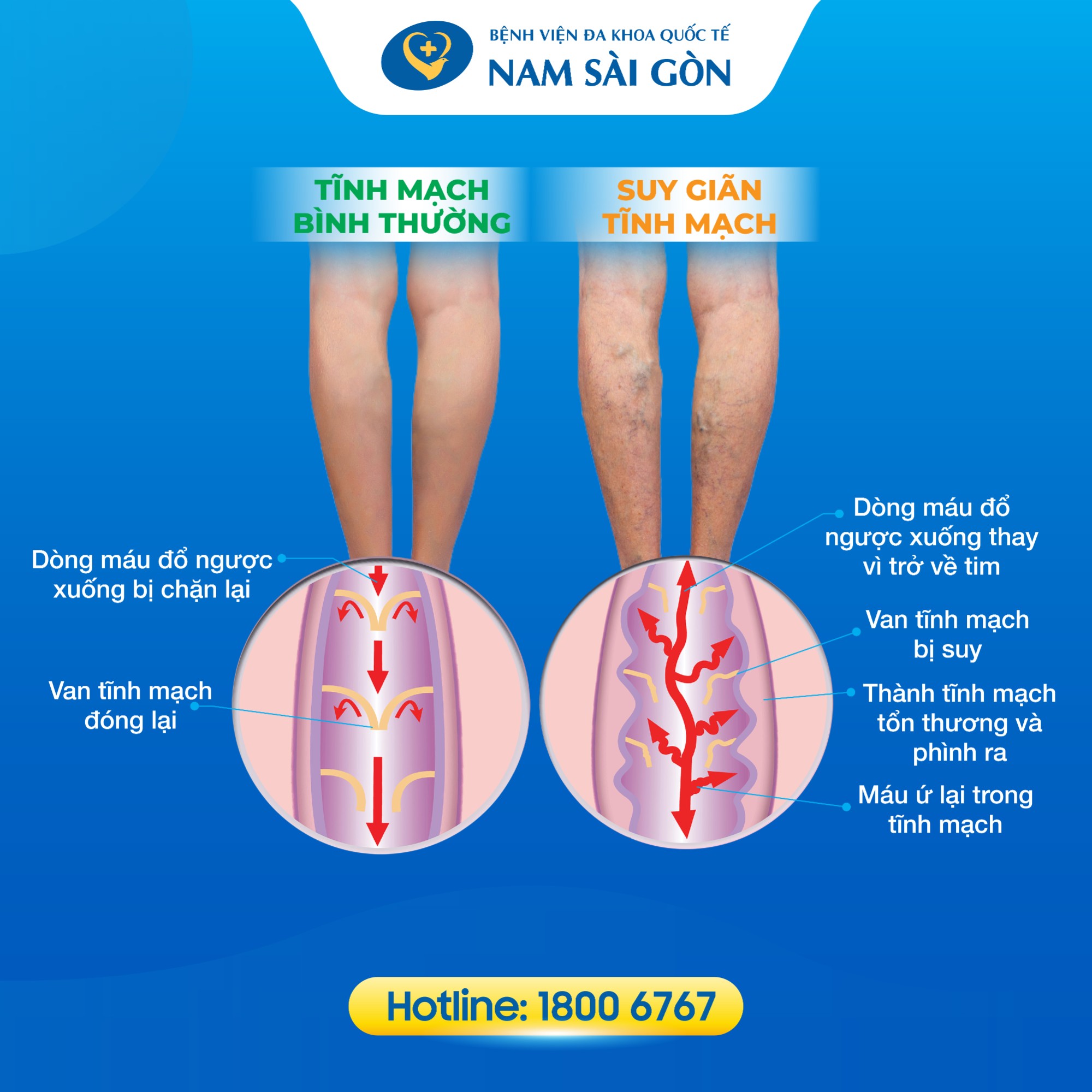 suy_gian_tinh_mach_chan_02_1