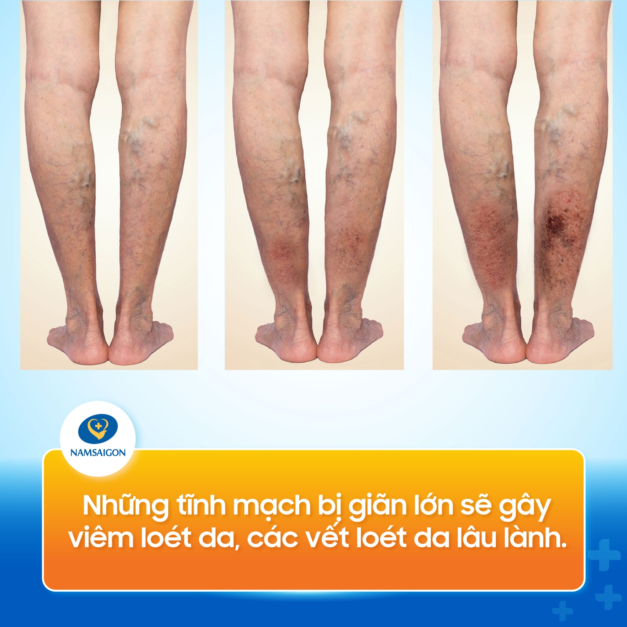 suy_gian_tinh_mach_chan_11